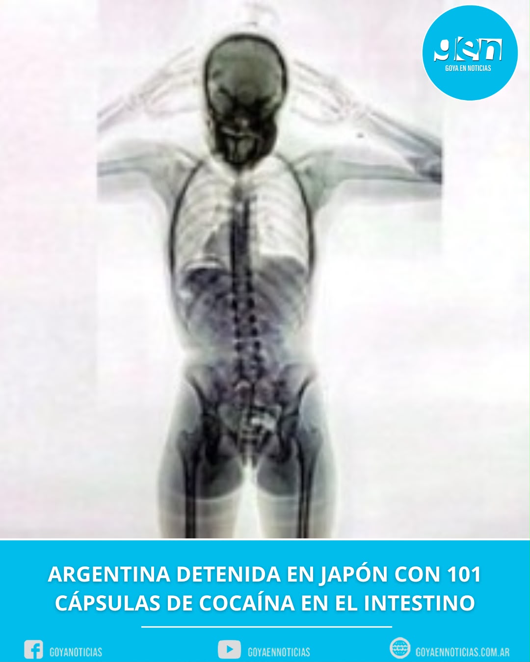Argentina detenida en Japón con 101 cápsulas de cocaína en el intestino